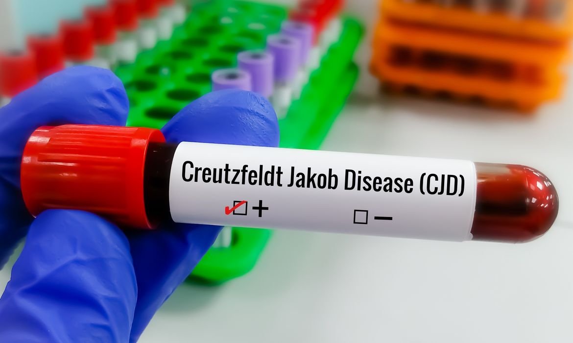 Creutzfeldt-Jakob esporádica: entenda a forma mais comum