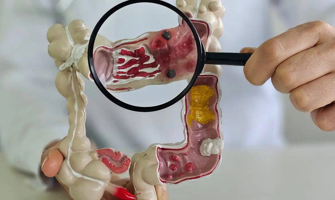 SUS registra aumento de doenças inflamatórias intestinais